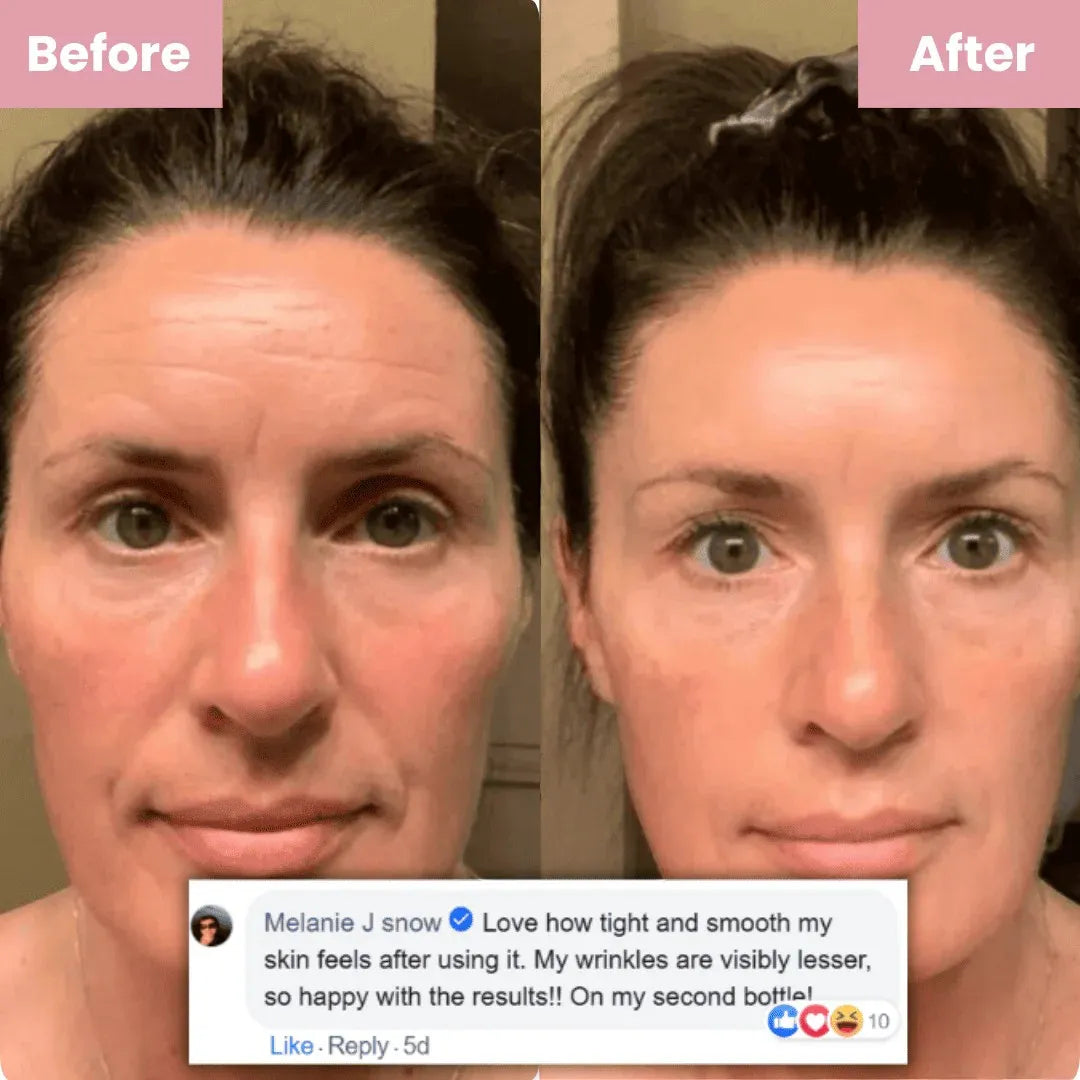 Before and after comparison of a woman's face with visible wrinkles, showing improved skin texture and fewer wrinkles.