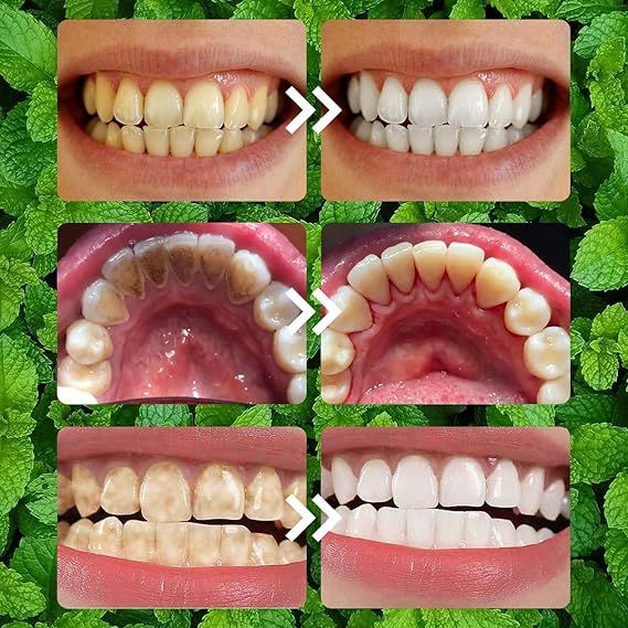 Before and after comparison of teeth whitening on a green leafy background