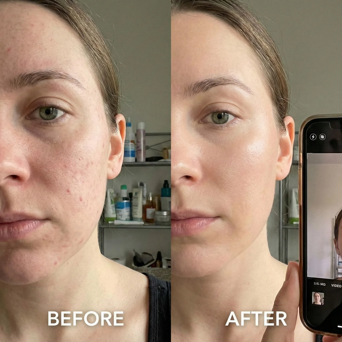 A split-screen before-and-after comparison of a woman's face, showing acne and blemishes on the left ('BEFORE') and clearer, smoother skin on the right ('AFTER'). A smartphone is visible on the right side, likely showing the video call or photo used for the comparison.