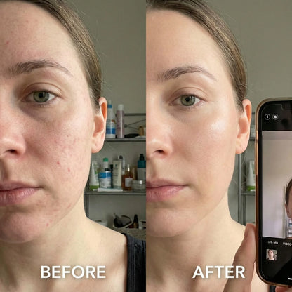 A split-screen before-and-after comparison of a woman's face, showing acne and blemishes on the left ('BEFORE') and clearer, smoother skin on the right ('AFTER'). A smartphone is visible on the right side, likely showing the video call or photo used for the comparison.