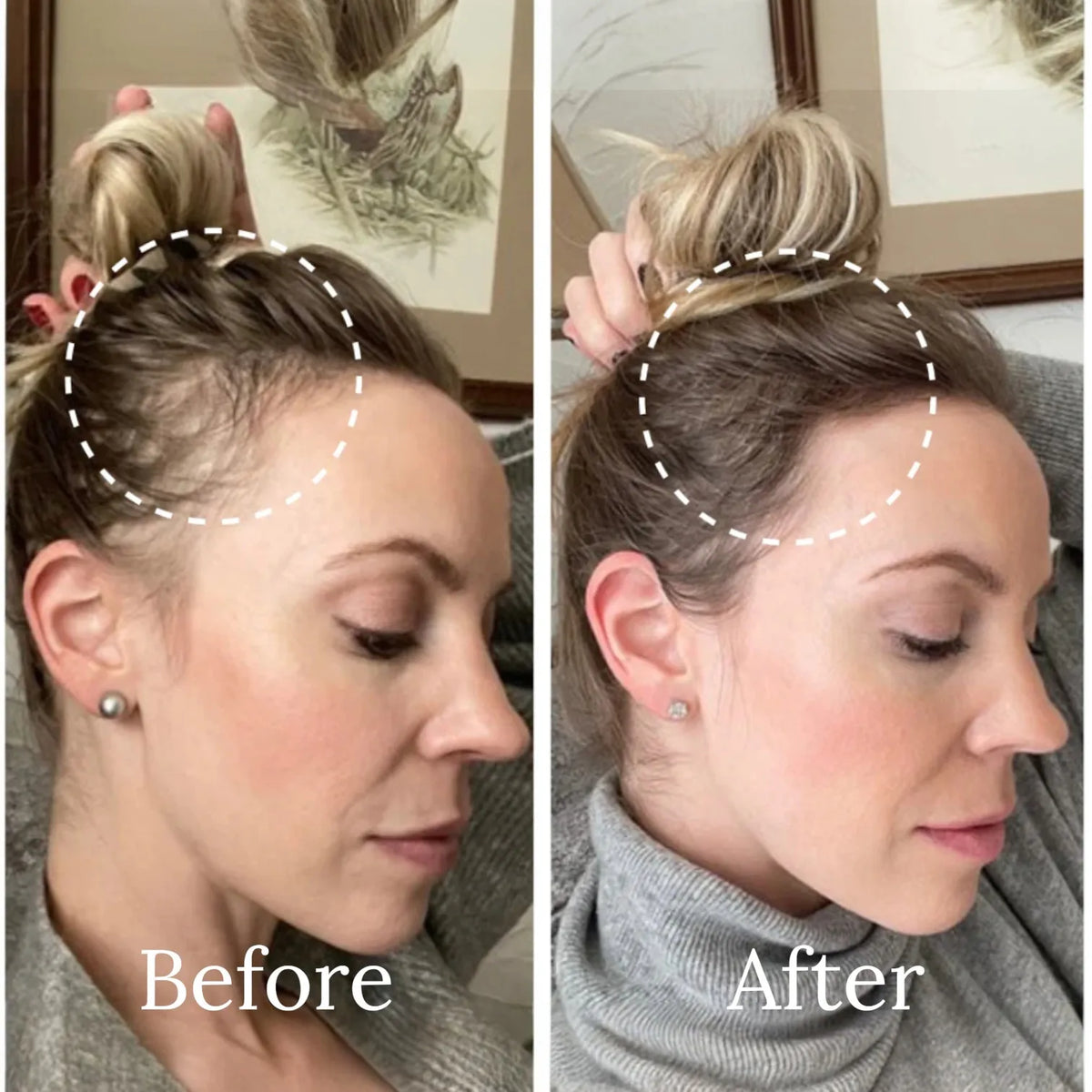 A side-by-side before and after comparison showing a woman's hairline and crown area. The left image is labeled 'Before' and shows a visible hairline with a loose bun hairstyle.