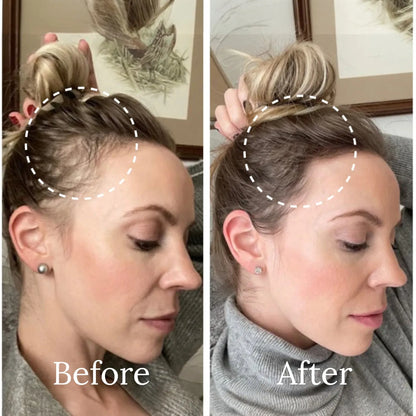 A side-by-side before and after comparison showing a woman's hairline and crown area. The left image is labeled 'Before' and shows a visible hairline with a loose bun hairstyle.